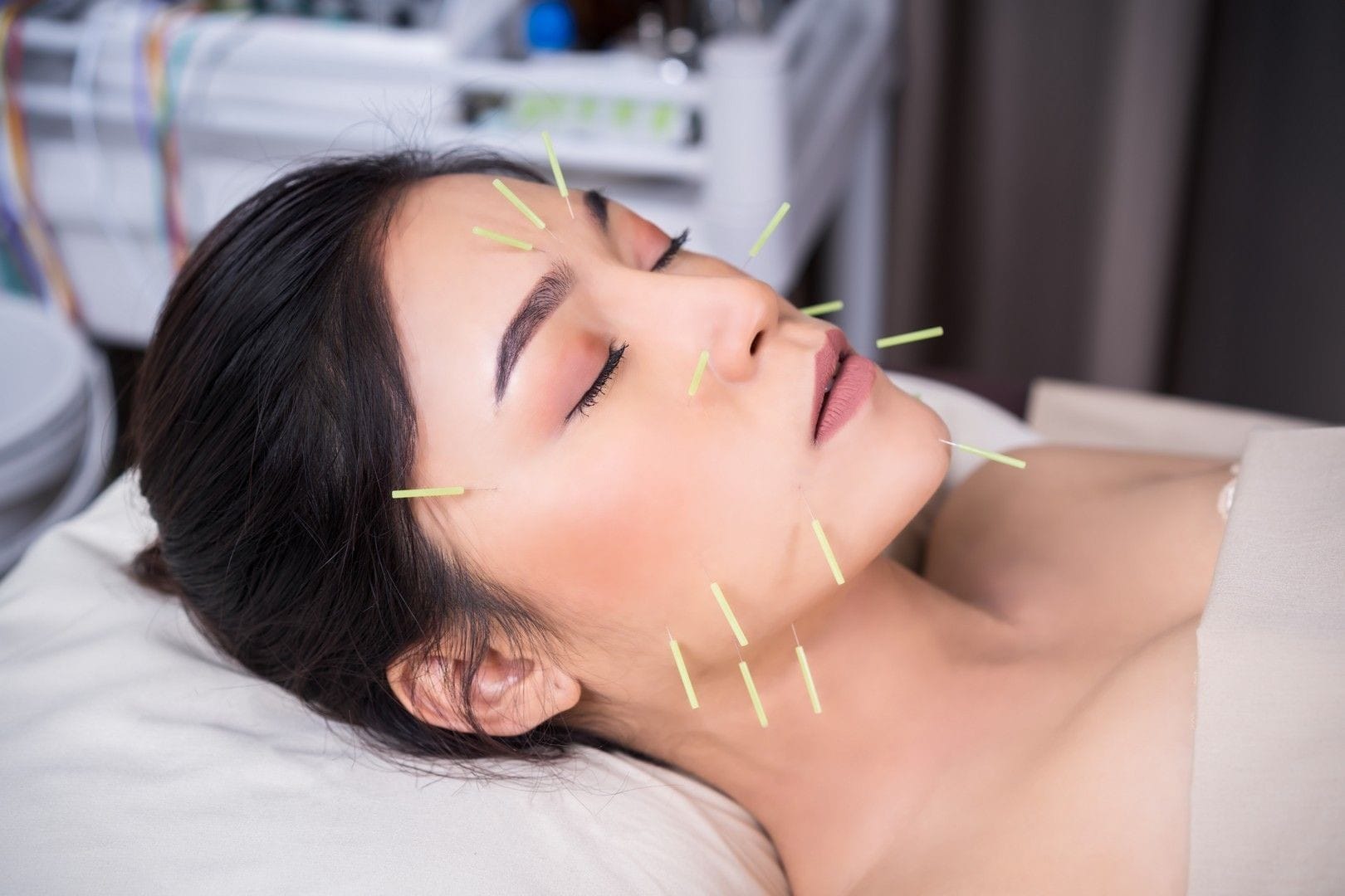 Acupuncture